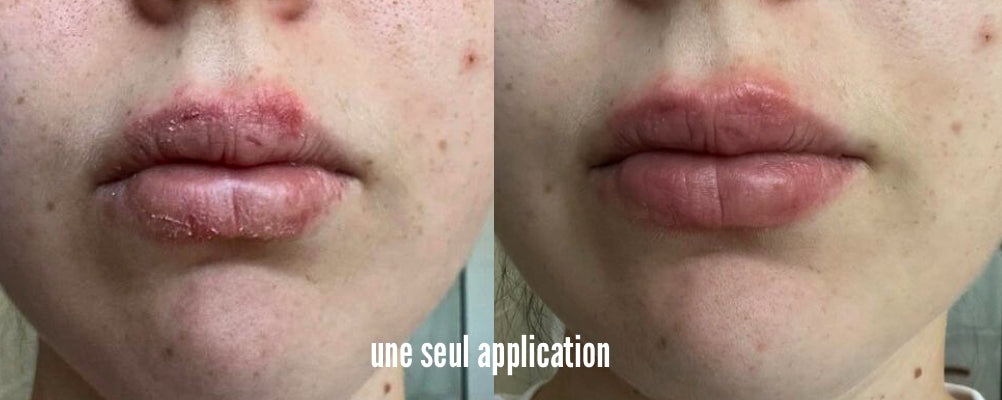 CONCOMBRE đ„ - MASQUE JELLY PEAU SĂCHE